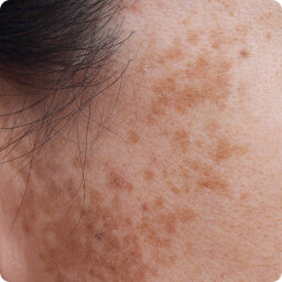 Melasma