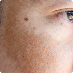 Sun/Age Spots