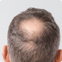 Bald Spots