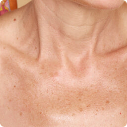 Neck Aging
