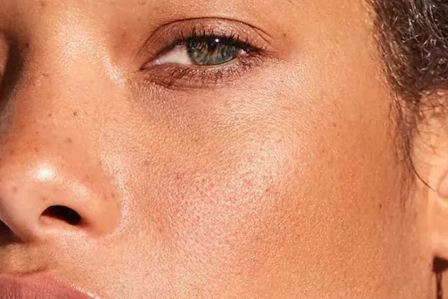 Uneven Skin Tone