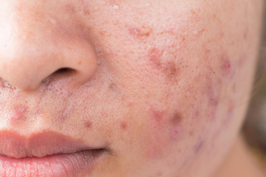 Post-Acne Marks