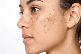 Dark Spots