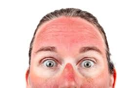 Sun Damage