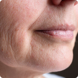 Menopausal Skin